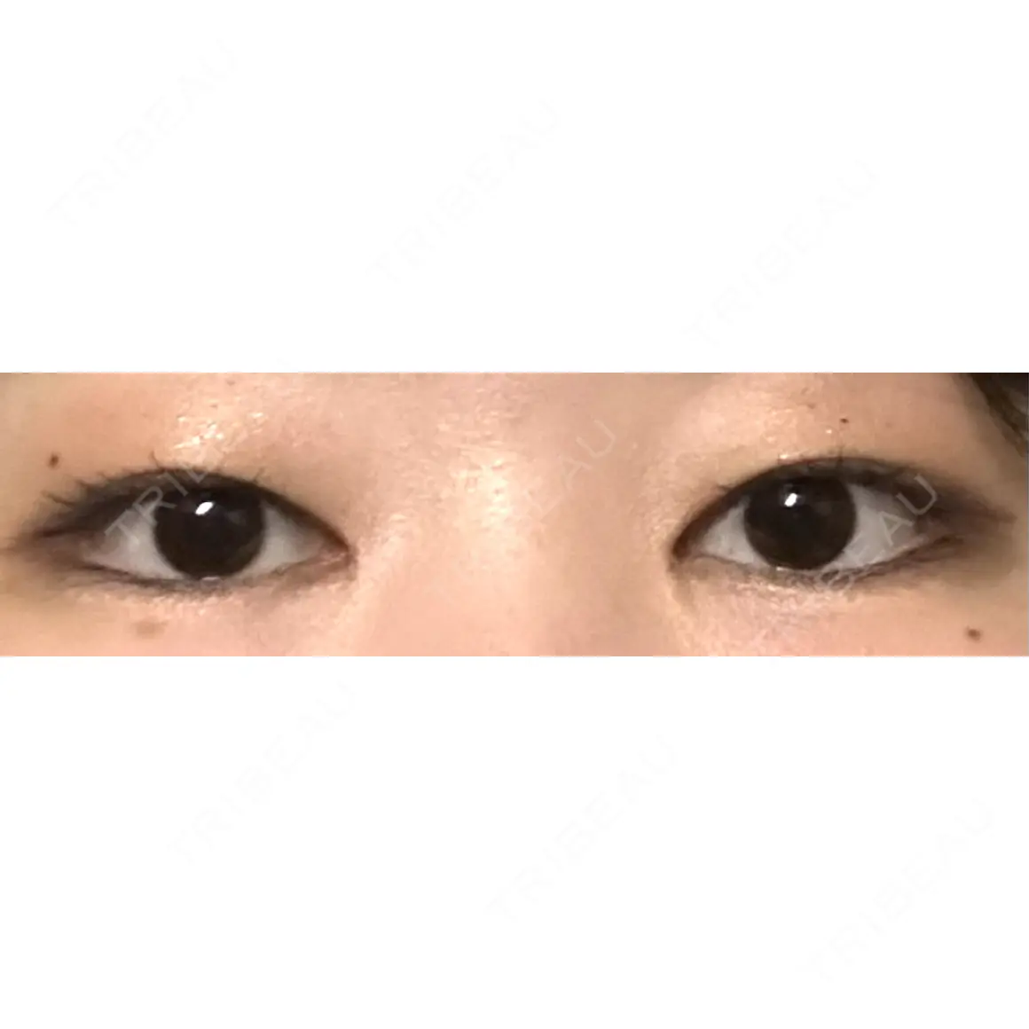 目頭切開 9BeautyClinic AFTER