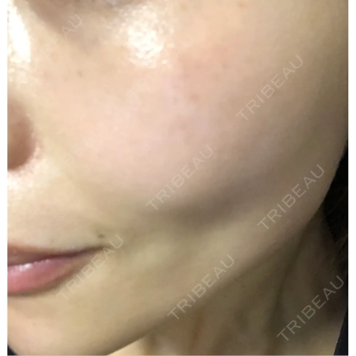ニードルRF（ポテンツァなど） Ledian Clinic六本木 AFTER