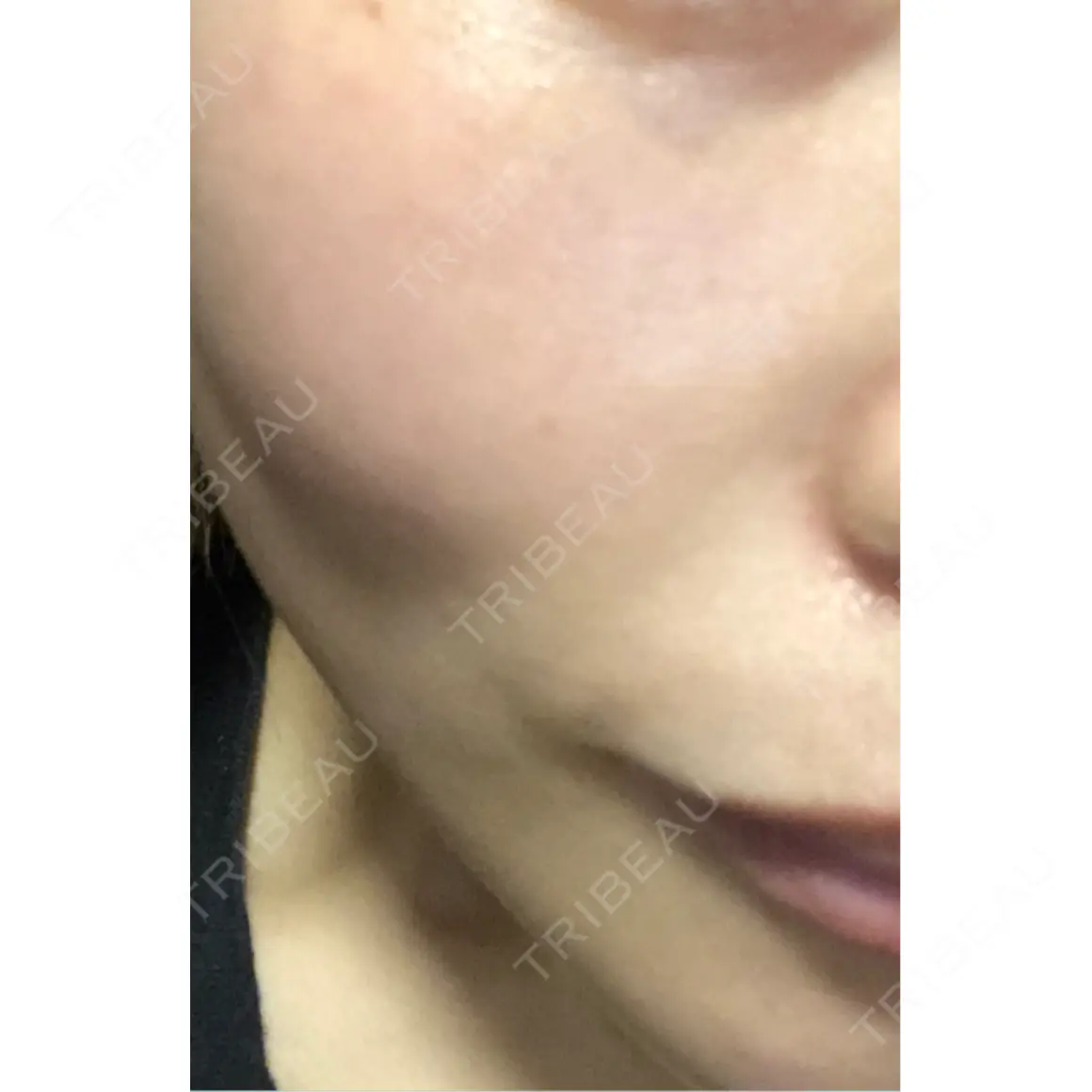 ニードルRF（ポテンツァなど） Ledian Clinic六本木 AFTER