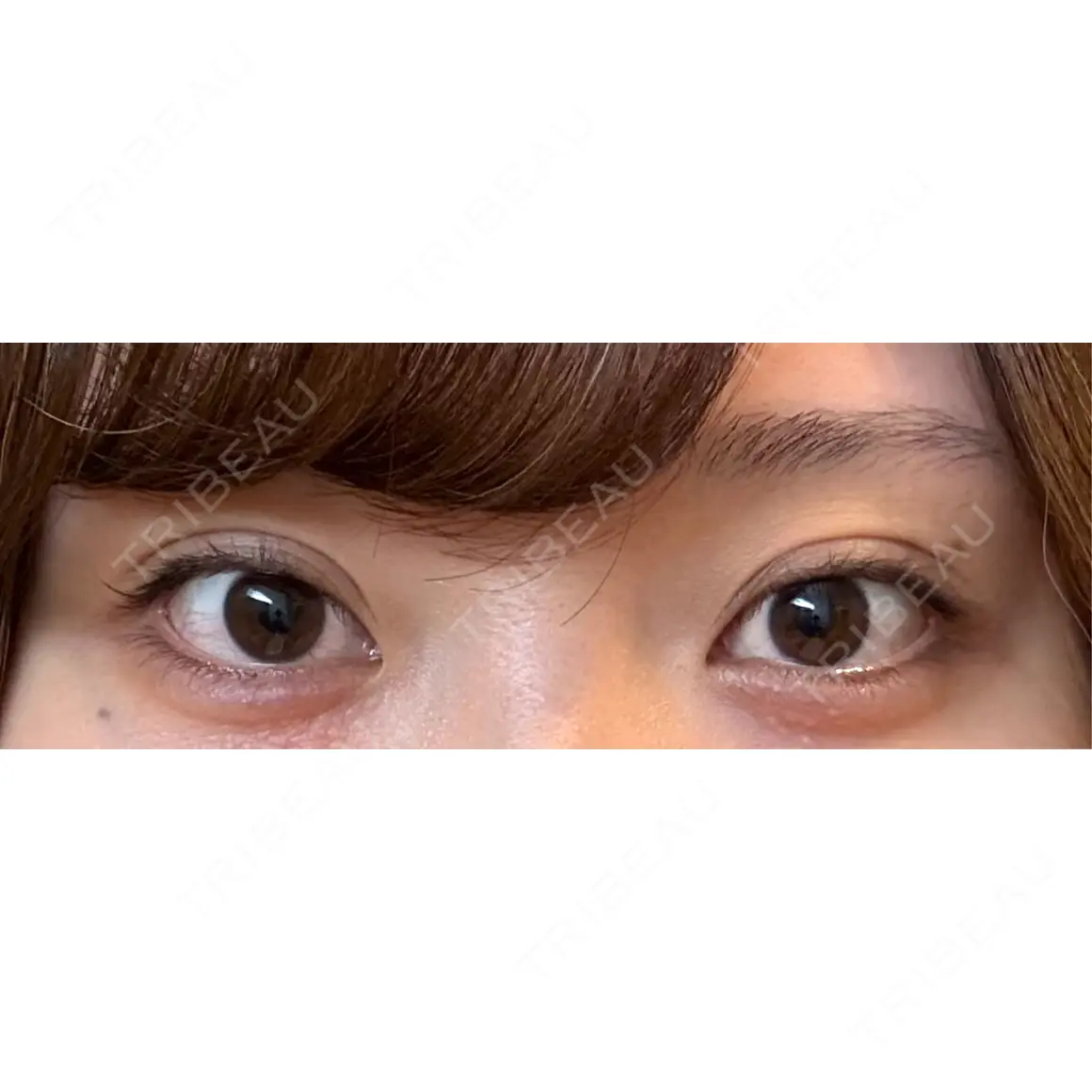 二重埋没 湘南美容クリニック 池袋東口院 AFTER