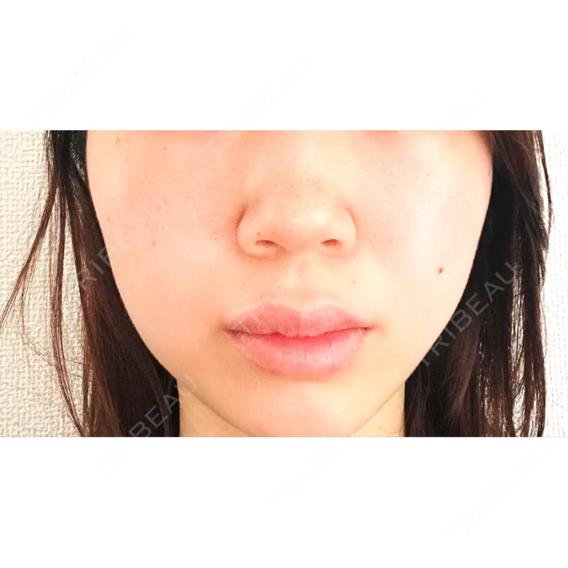 毛穴洗浄（ハイドラフェイシャルなど） / ルメッカ CZEN CLINIC 銀座院 AFTER