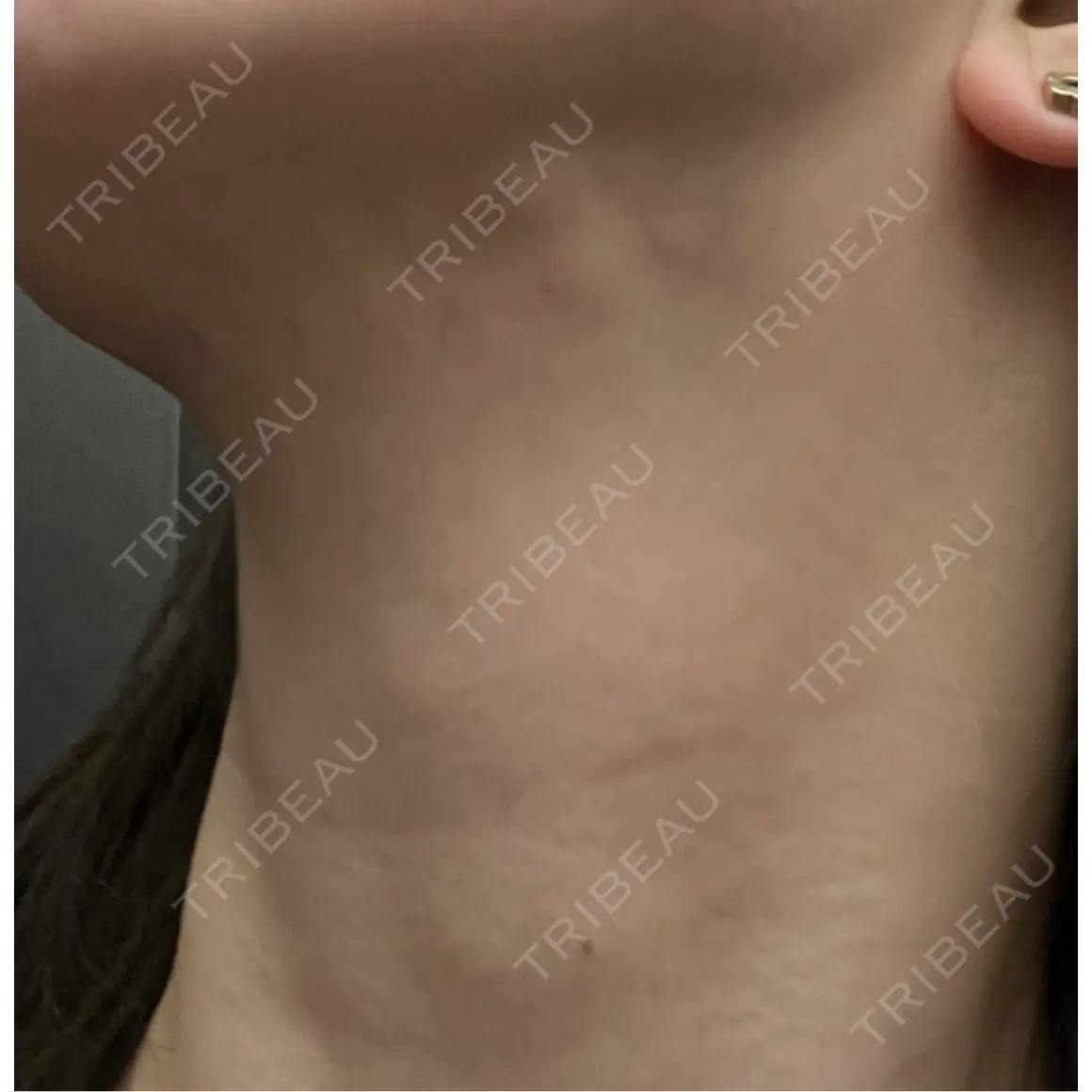 ボトックス（首） PRO CLINIC プロクリニック 銀座院 AFTER