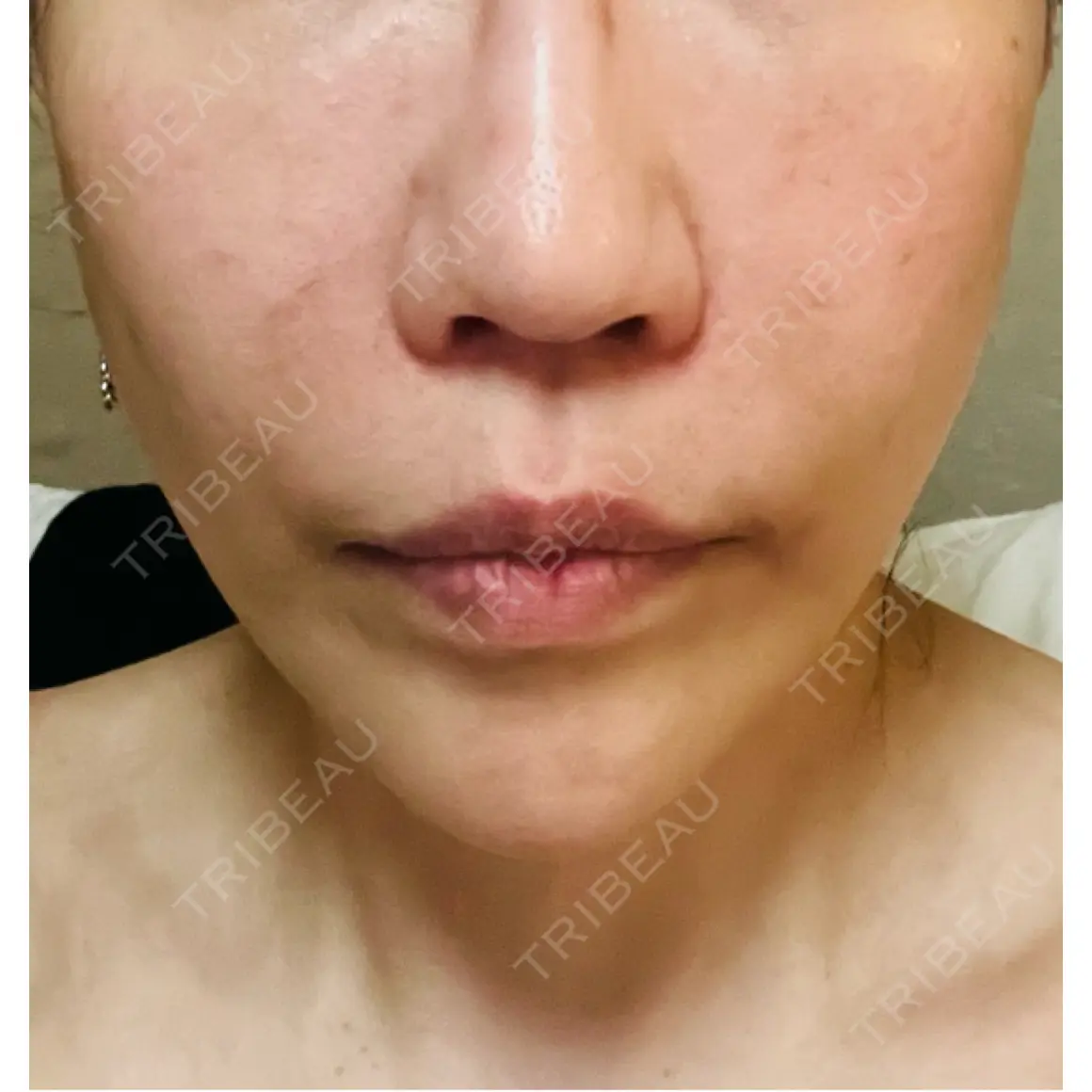 ハイフ（顔） WellnessPlus Clinic 【ウェルネスプラスクリニック】 AFTER