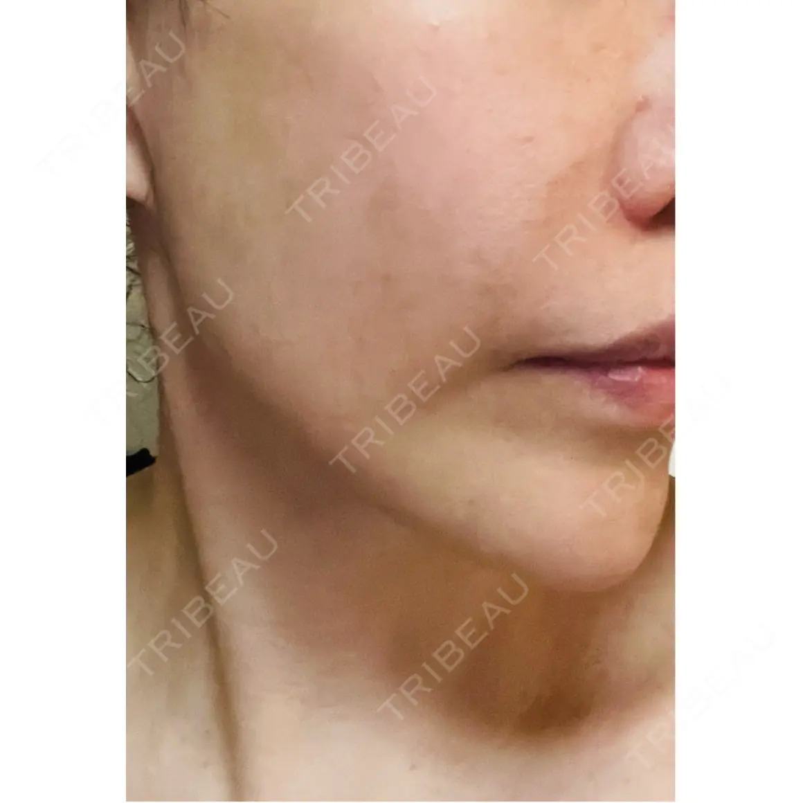 ハイフ（顔） WellnessPlus Clinic 【ウェルネスプラスクリニック】 AFTER