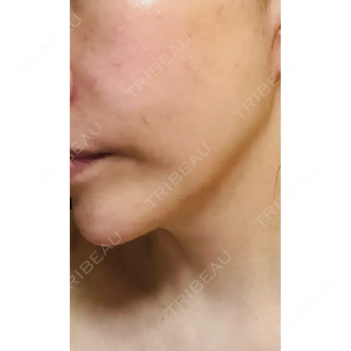 ハイフ（顔） WellnessPlus Clinic 【ウェルネスプラスクリニック】 AFTER