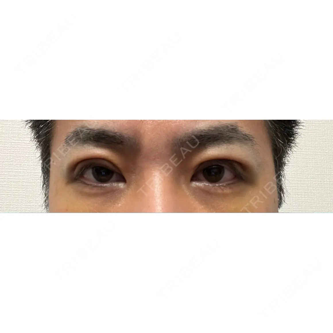二重切開 / 眼瞼下垂（切開） / 上まぶたたるみ取り / 上まぶたの脂肪取り オーキッド美容クリニック東京御徒町 DAY 6
