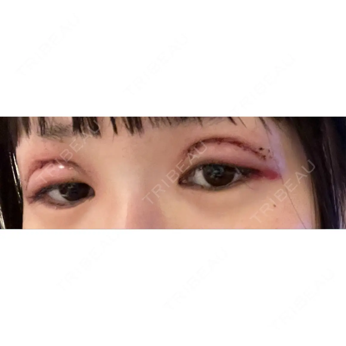 二重切開 / 眼瞼下垂（切開） / 上まぶたの脂肪取り / ヒアルロン酸注入（涙袋） / ヒアルロン酸注入（唇） 東京シンデレラ美容外科 新宿院 DAY 1