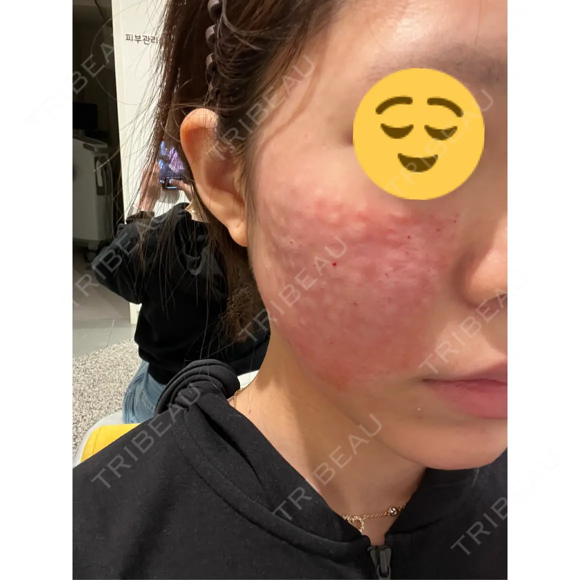 水光注射（ハリ・美肌） / マイクロボトックス / 光治療（フォトフェイシャルなど） / レーザートーニング（美白・肝斑） / リジュラン バログ医院 江南院 DAY 0