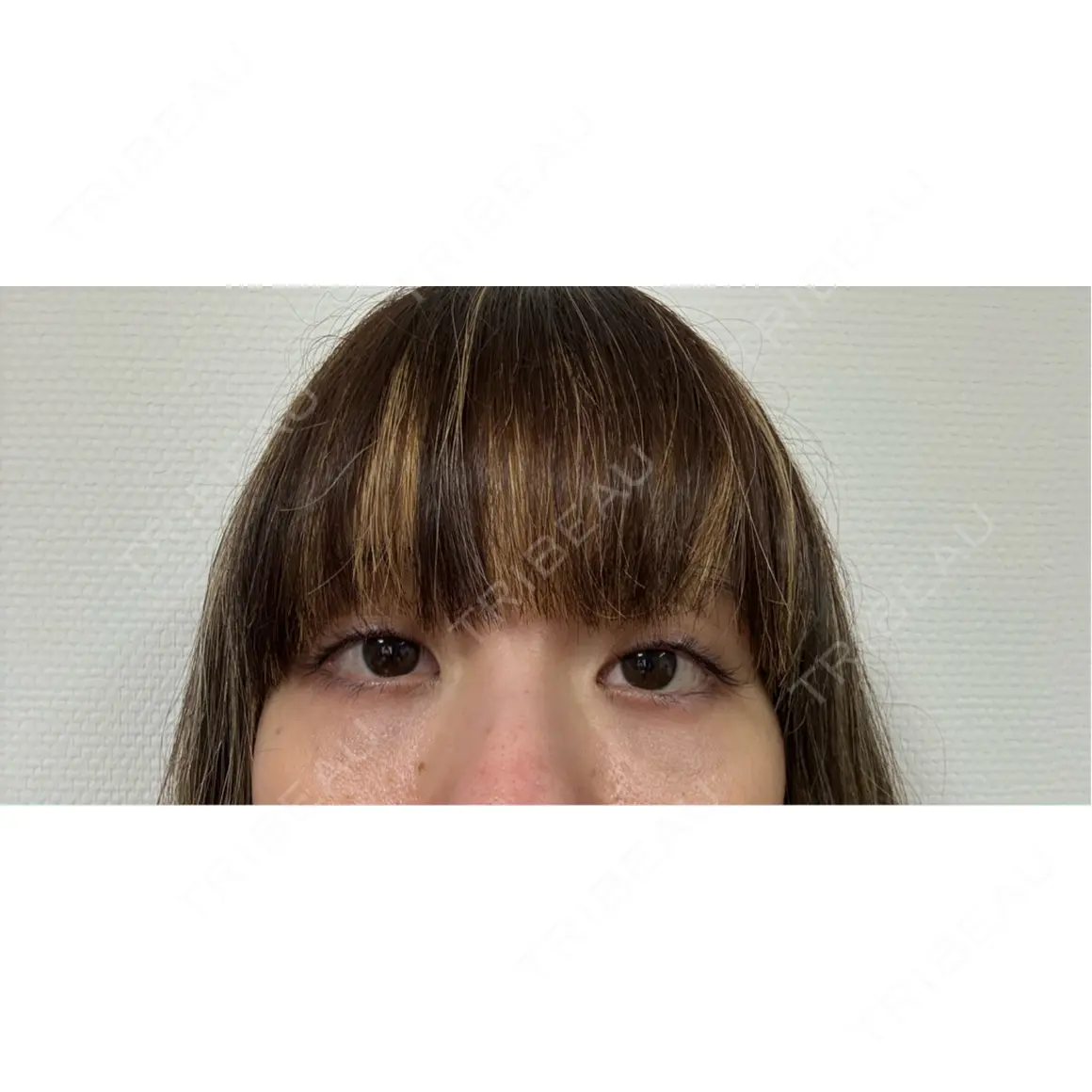 クマ治療 / 脂肪注入（肌） eクリニック 那覇院 AFTER