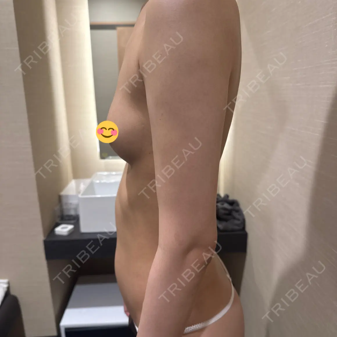 脂肪吸引（脚） / 豊胸（シリコンバッグ） / 豊胸（脂肪注入） / 脂肪注入（輪郭） AVAN TOKYO 銀座脂肪吸引 クリニック DAY 0