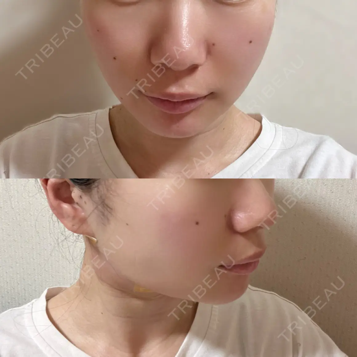 糸リフト / バッカルファット除去 / 脂肪吸引（顔） / ジョールファット除去 / ボトックス（あご） / ボトックス（エラ・小顔） アリエル美容クリニック 大宮院 DAY 1