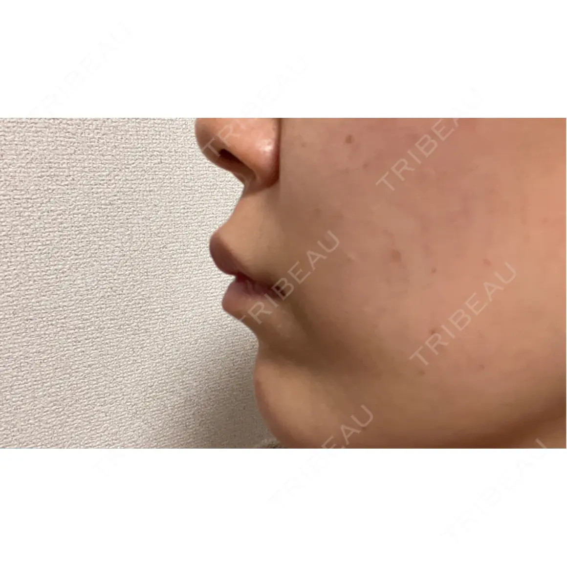 ボトックス（人中） eクリニック 横浜みなとみらい院 AFTER
