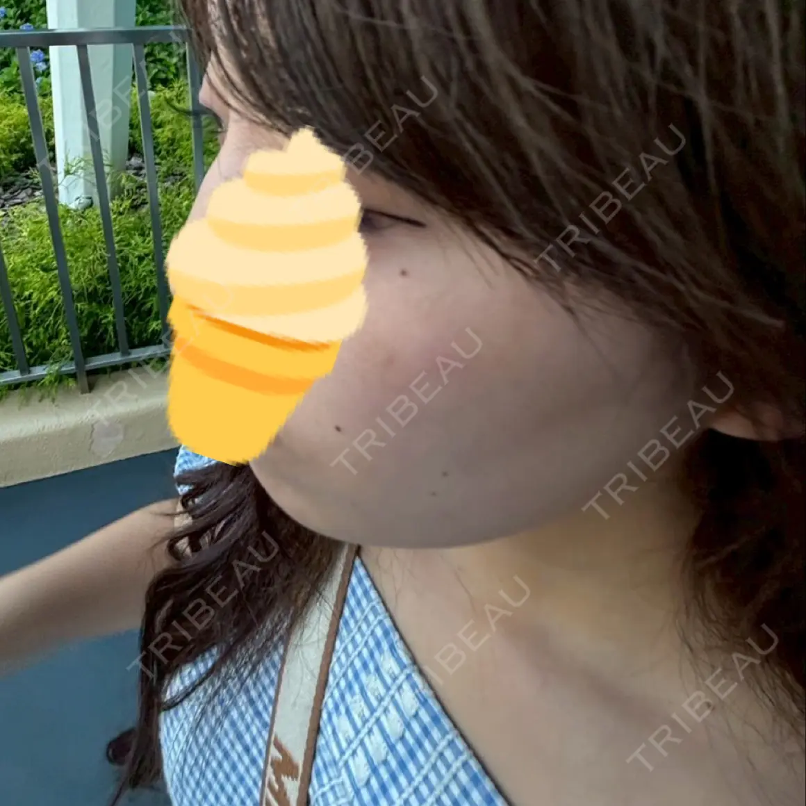 ボトックス（エラ・小顔） TCB東京中央美容外科 金山院 AFTER