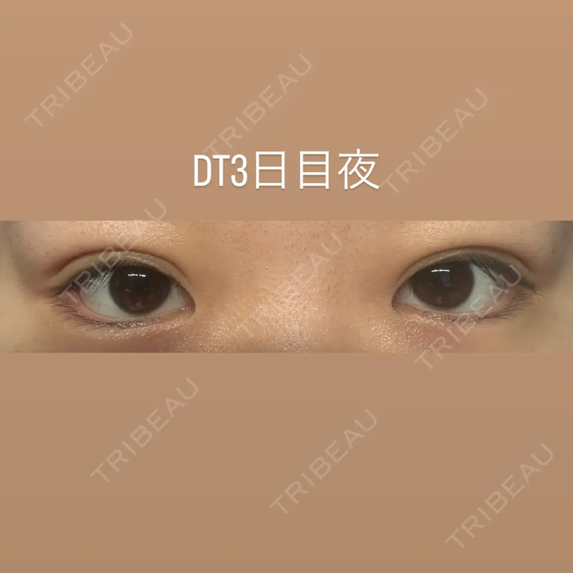 二重埋没 ルラ美容クリニック 札幌院 AFTER