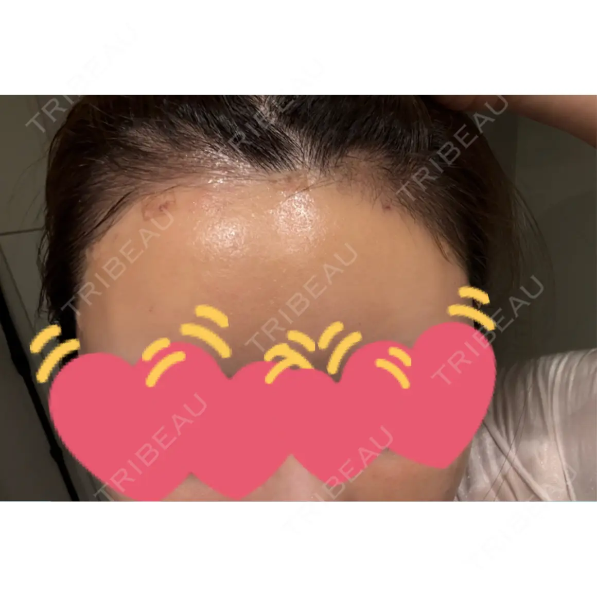 脂肪吸引（顔） / 脂肪吸引（二の腕） / 豊胸（脂肪注入） / 脂肪注入（額） / 脂肪吸引（肩） / 脂肪注入（輪郭） 藤・ナチュレ美容クリニック 銀座院 DAY 1