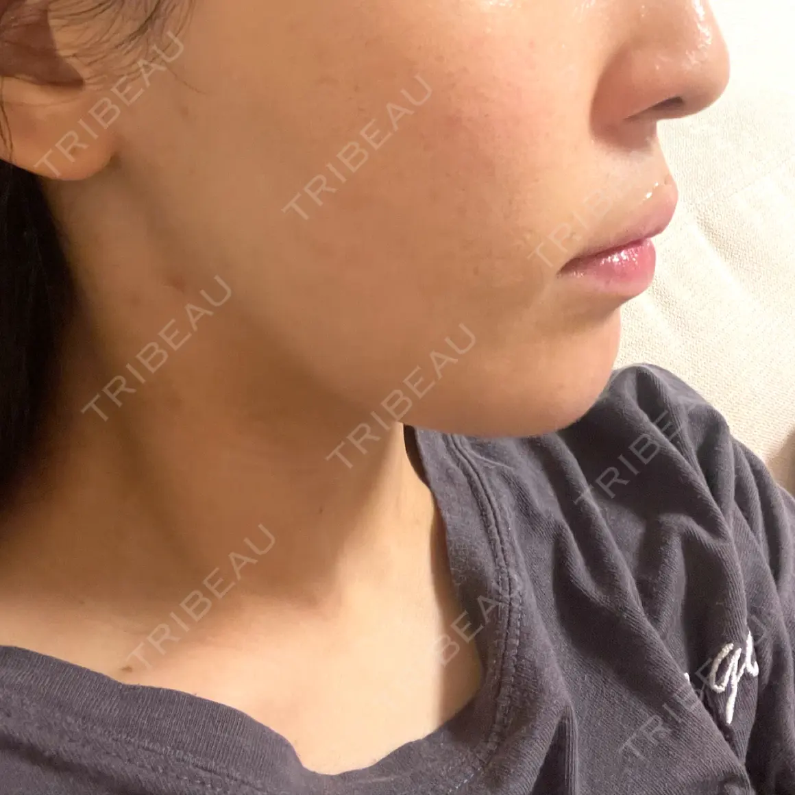 糸リフト / 脂肪吸引（顔） / 脂肪吸引注射（顔） ziz CLINIC AFTER