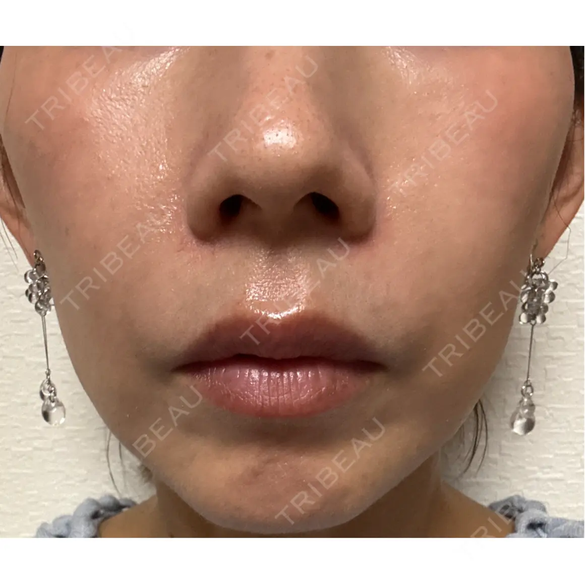 ヒアルロン酸注入（頬） / ボトックス（目尻） / その他（口元） フィラークリニック 福岡院 AFTER