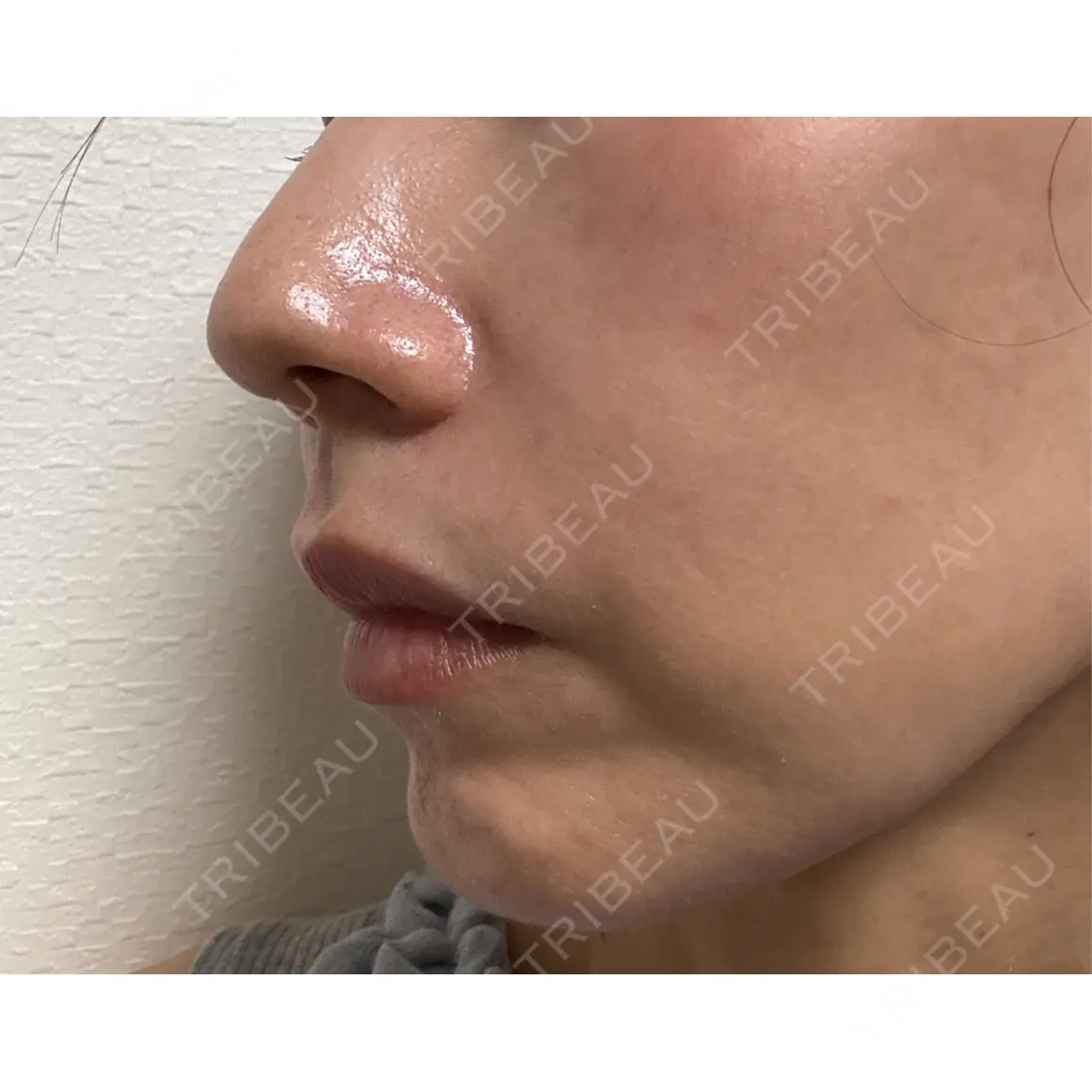 ヒアルロン酸注入（頬） / ボトックス（目尻） / その他（口元） フィラークリニック 福岡院 AFTER