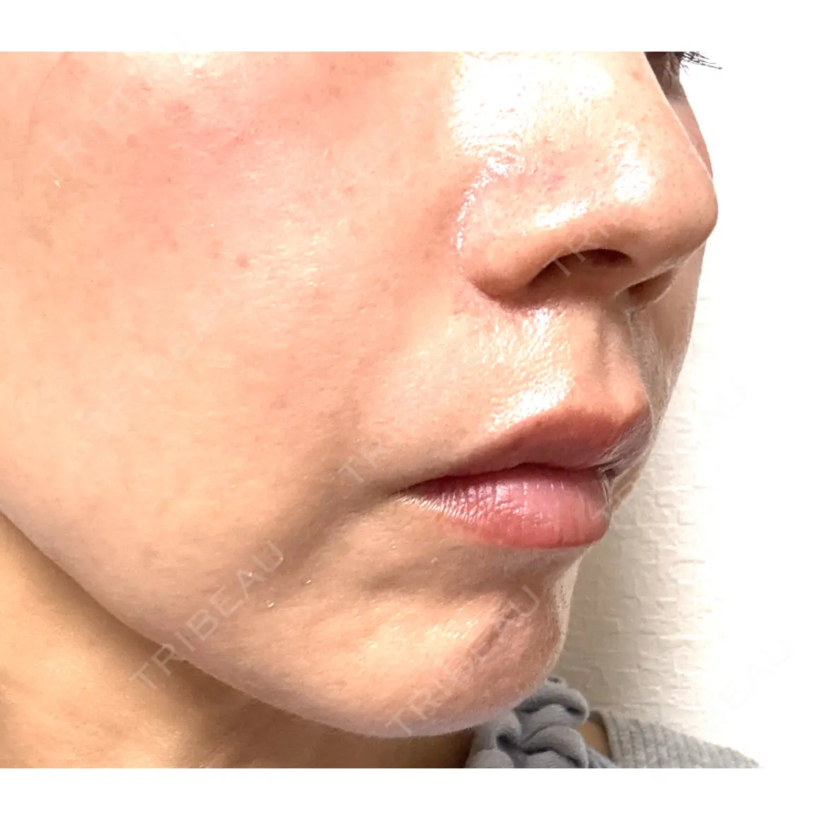 ヒアルロン酸注入（頬） / ボトックス（目尻） / その他（口元） フィラークリニック 福岡院 AFTER