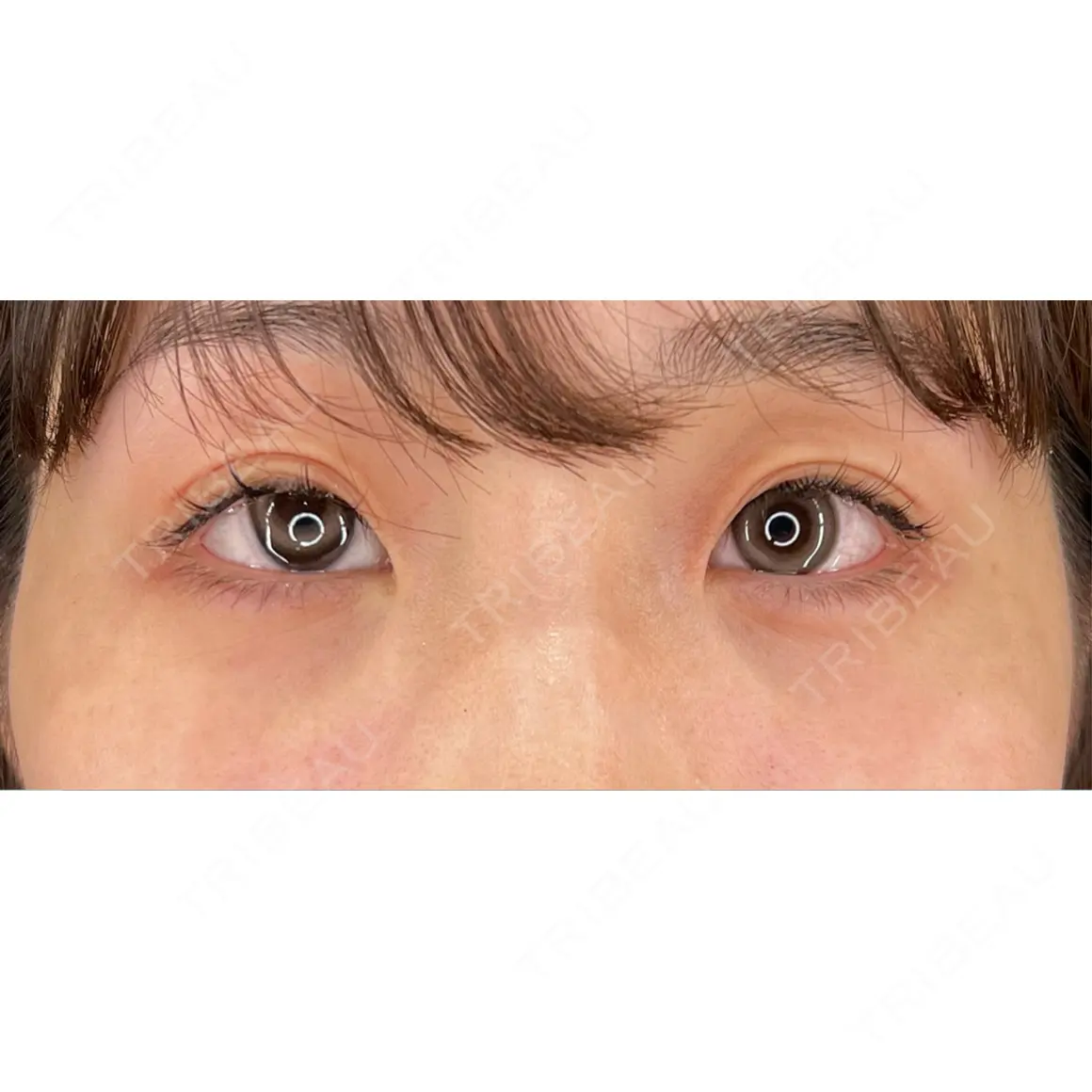 ヒアルロン酸注入（涙袋） / ヒアルロン酸注入（唇） HAAB×DREAM BEAUTY CLINIC 大阪梅田院 AFTER