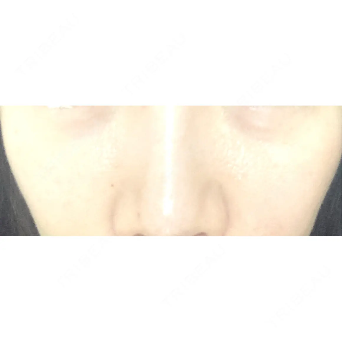 その他（目元） ブルームクリニック（BLOOM CLINIC） AFTER