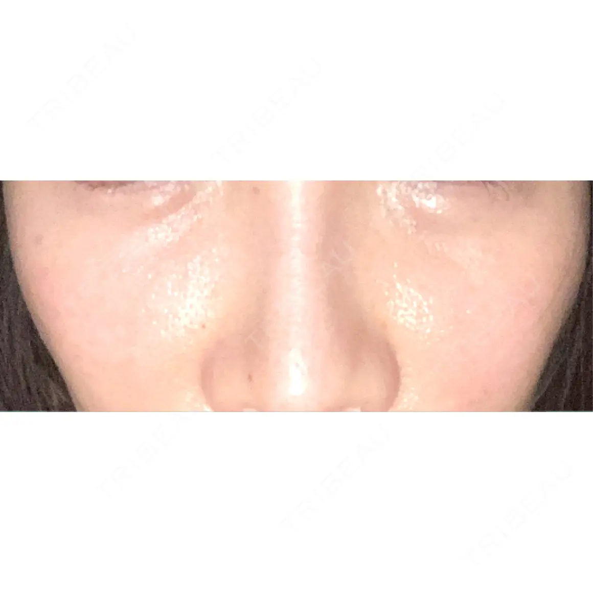 その他（目元） ブルームクリニック（BLOOM CLINIC） AFTER