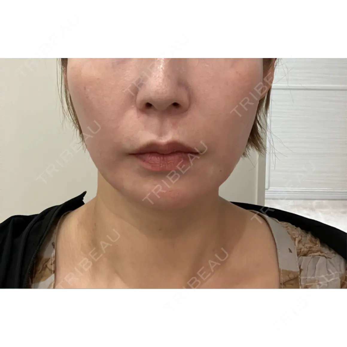 ボトックス（あご） / ボトックス（エラ・小顔） / ボトックス（口角） / ボトックス（人中） ルラ美容クリニック 渋谷本院 DAY 0
