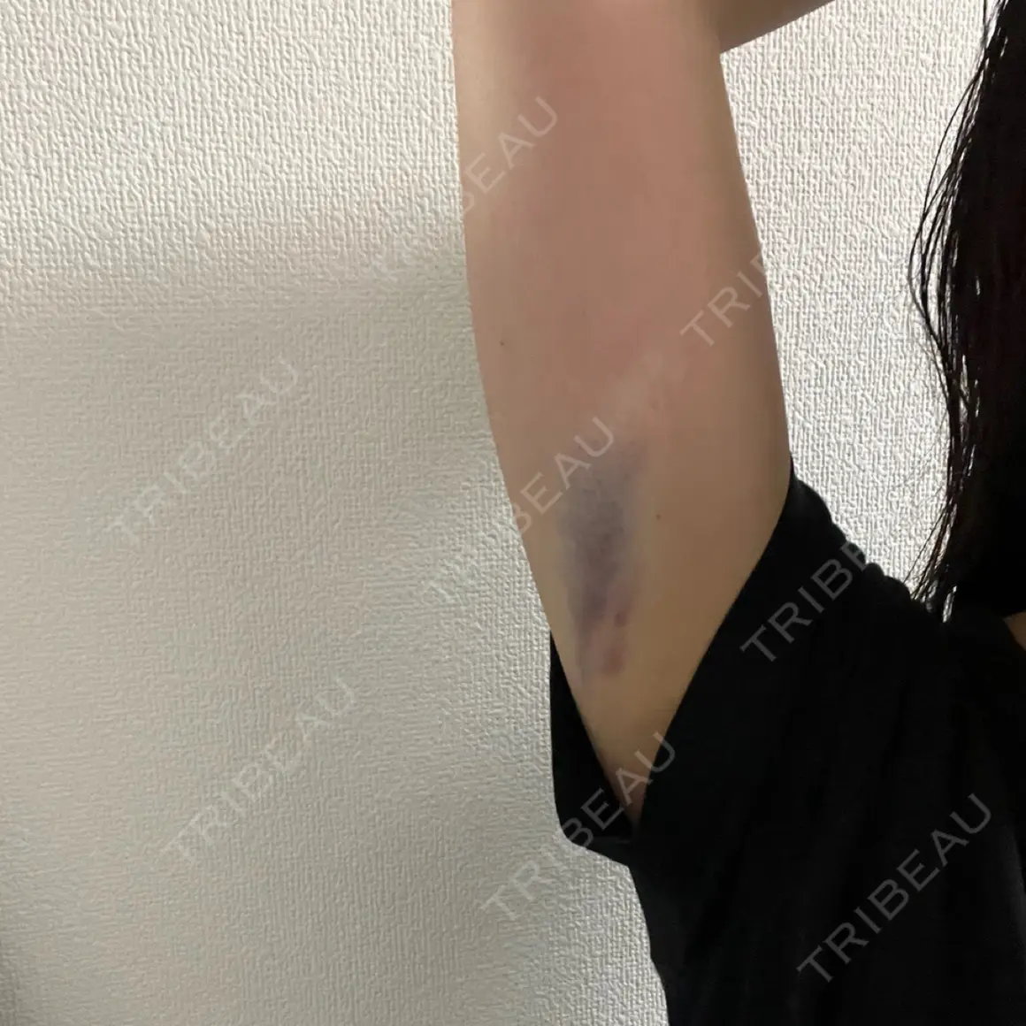 脂肪溶解注射（二の腕） ルラ美容クリニック 大阪心斎橋院 DAY 0