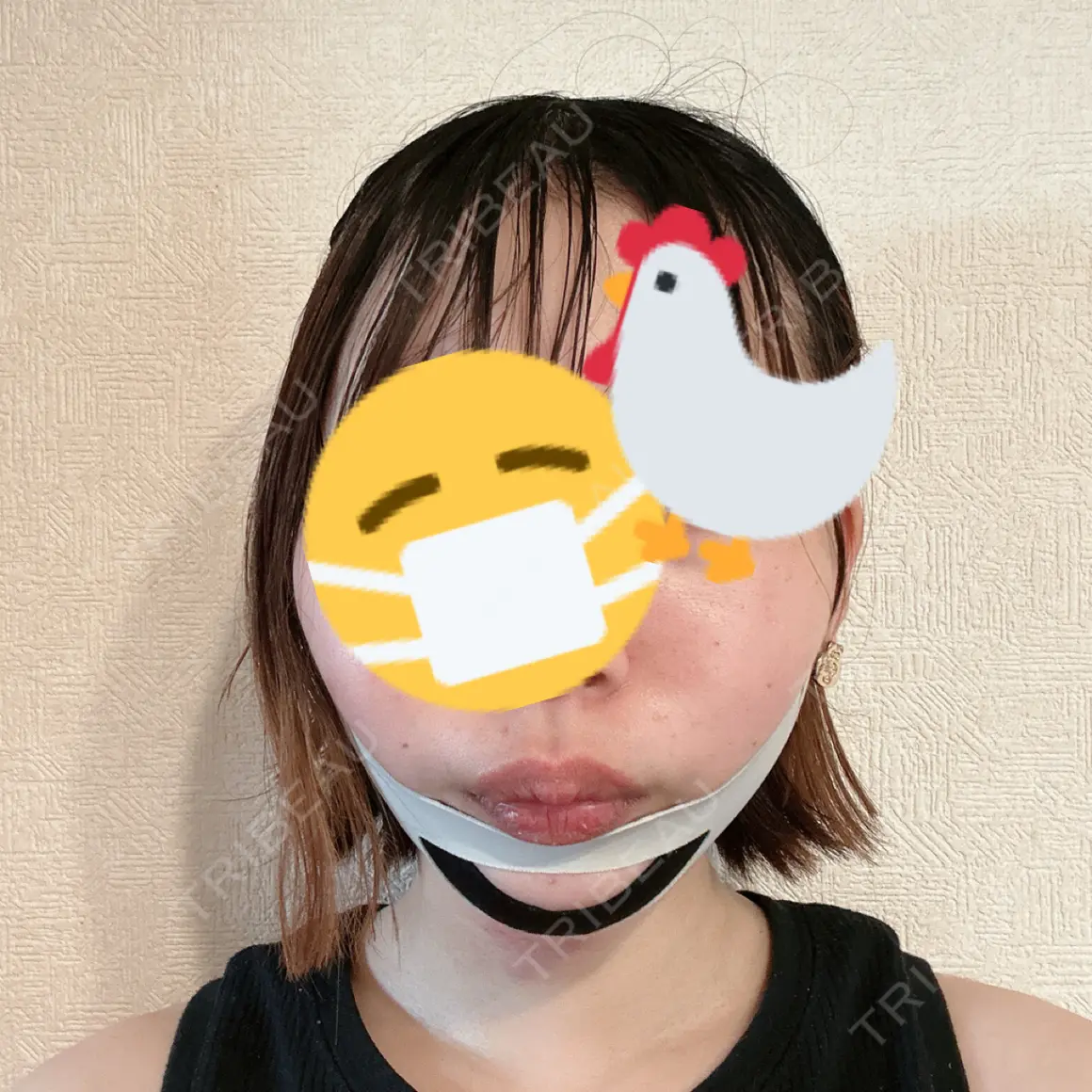 脂肪吸引（顔） ルラ美容クリニック 上野院 DAY 1