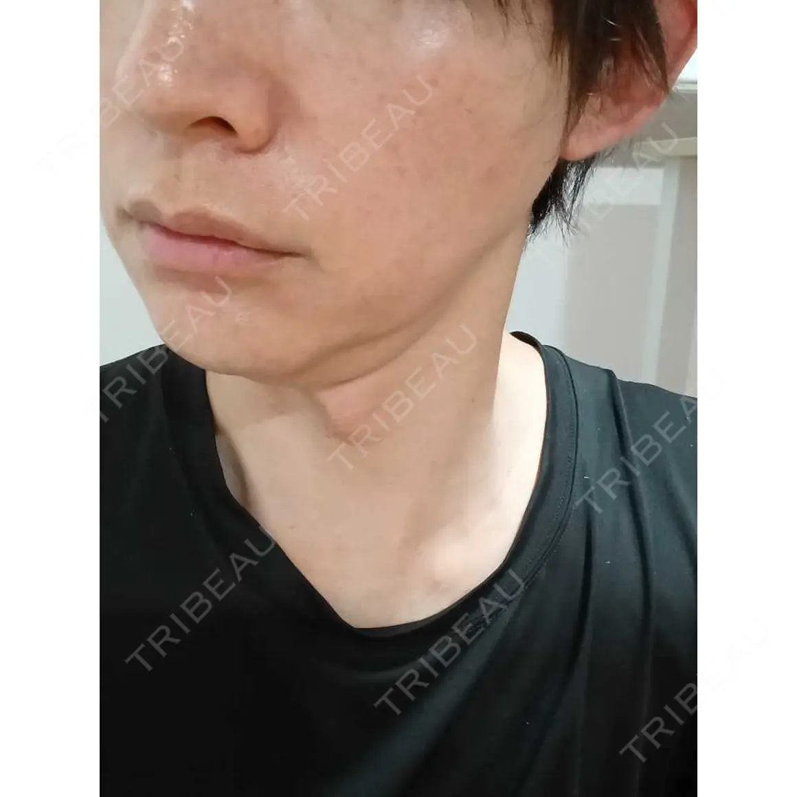 ルメッカ ルラ美容クリニック 名古屋本院 AFTER