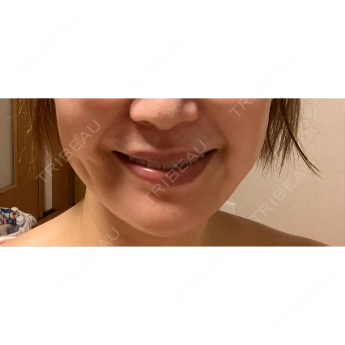 ボトックス（あご） / ボトックス（エラ・小顔） / ボトックス（口角） / ボトックス（人中） ルラ美容クリニック 渋谷本院 AFTER