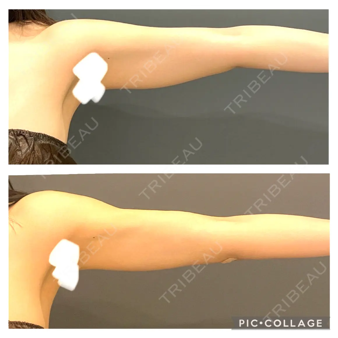 脂肪吸引（二の腕） オアシス美容外科 AFTER