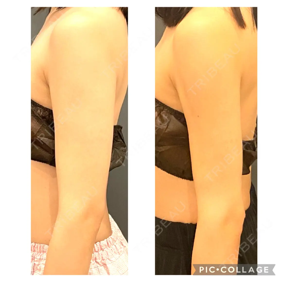 脂肪吸引（二の腕） オアシス美容外科 AFTER