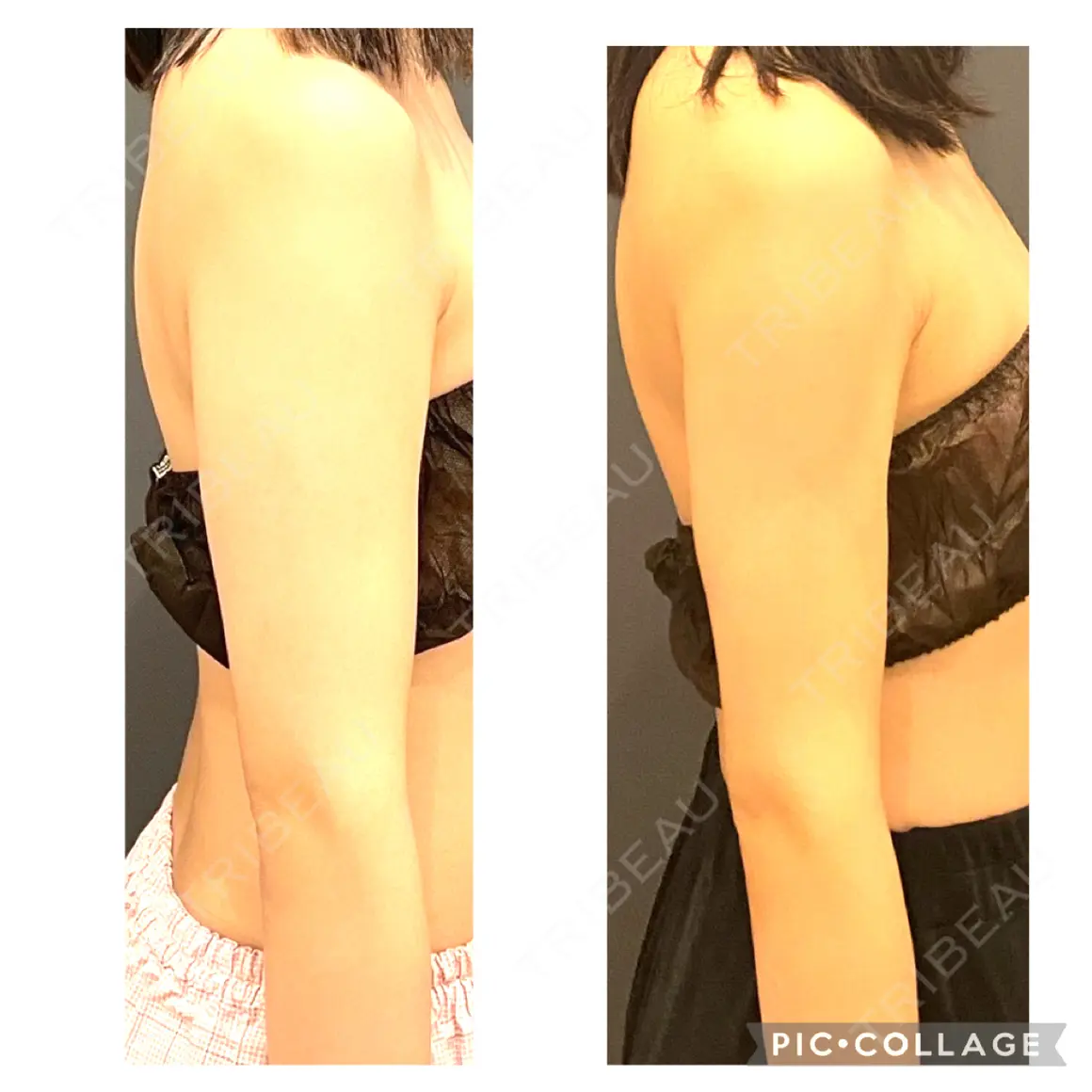 脂肪吸引（二の腕） オアシス美容外科 AFTER