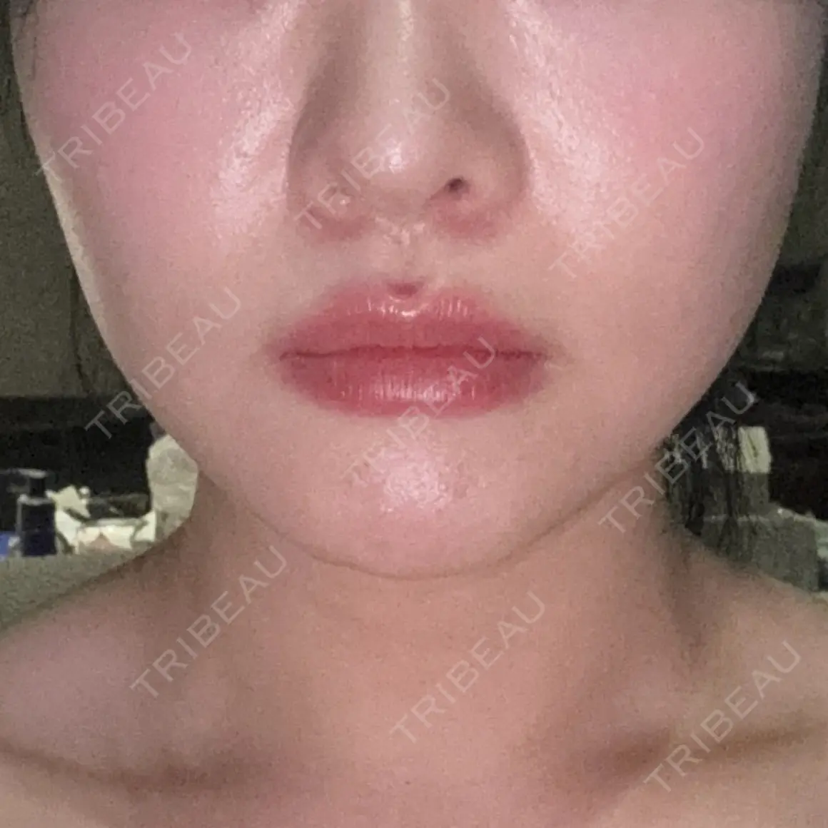 ハイフ（顔） / RF（高周波）たるみ治療 CZEN CLINIC 銀座院 AFTER