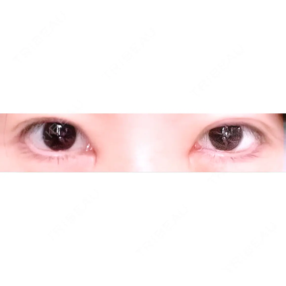 目頭切開 Stand by Beauty Clinic AFTER