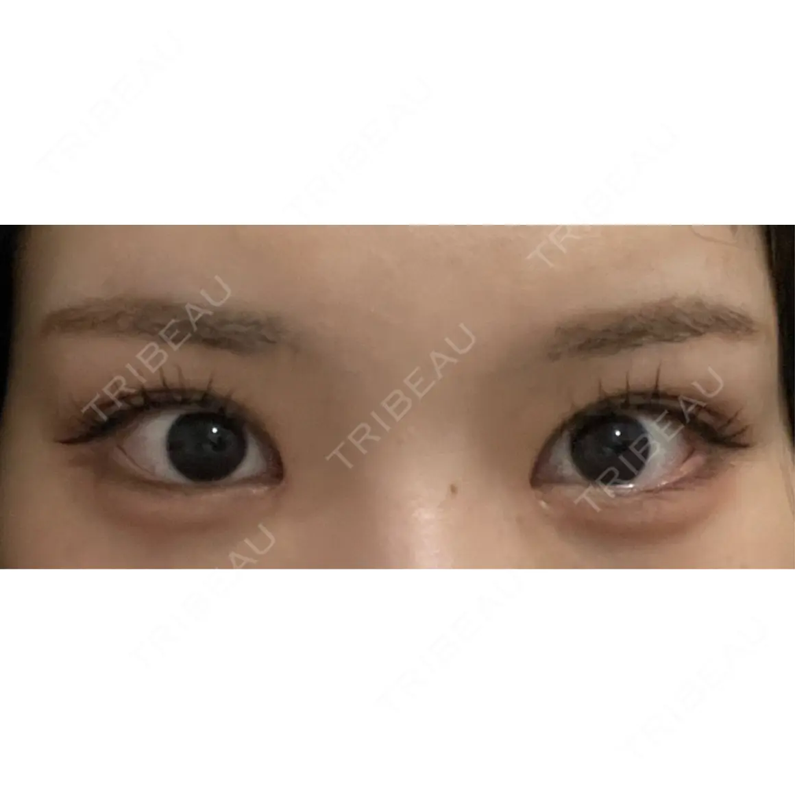 二重埋没 / 目頭切開 9BeautyClinic AFTER