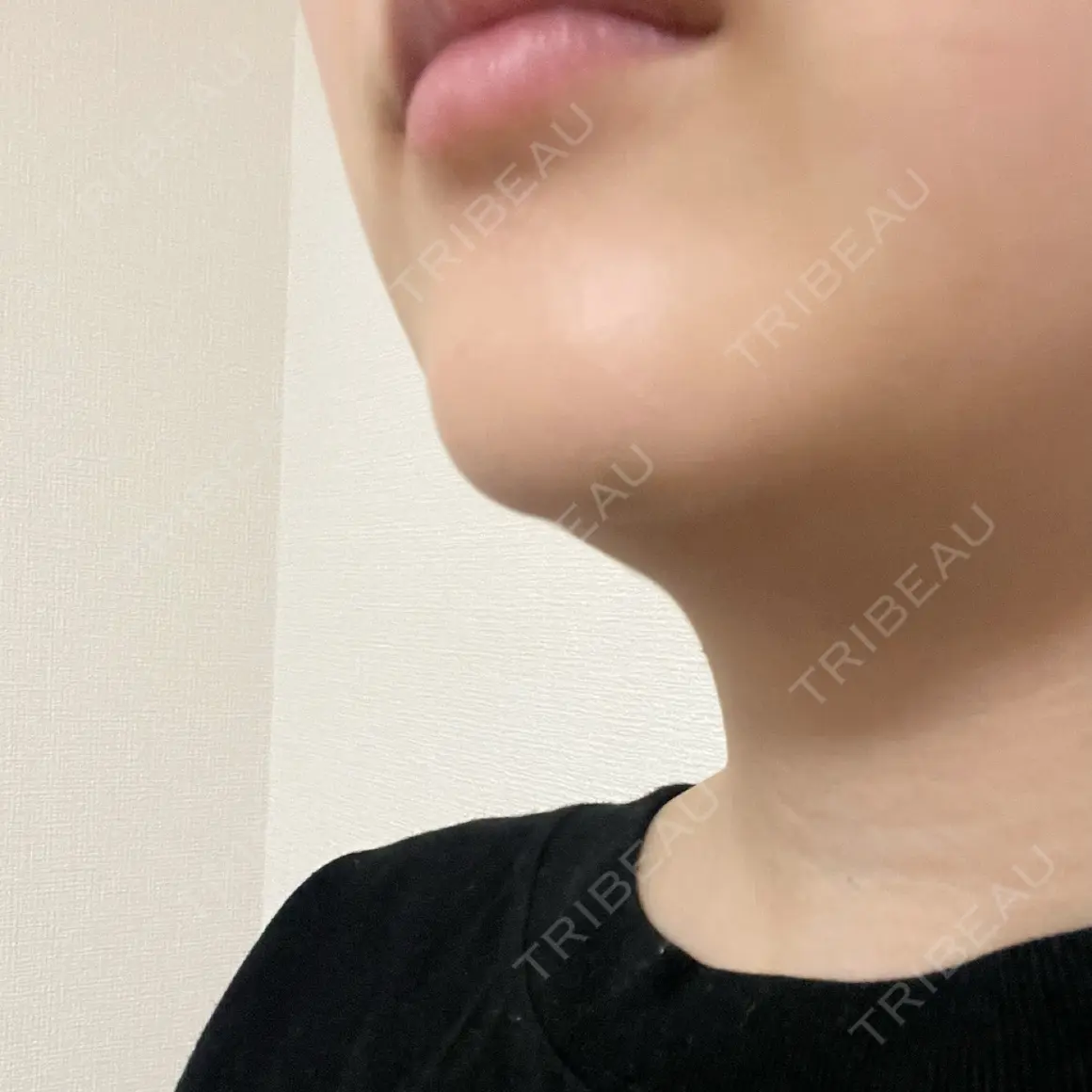 ボトックス（あご） ルラ美容クリニック 札幌院 AFTER