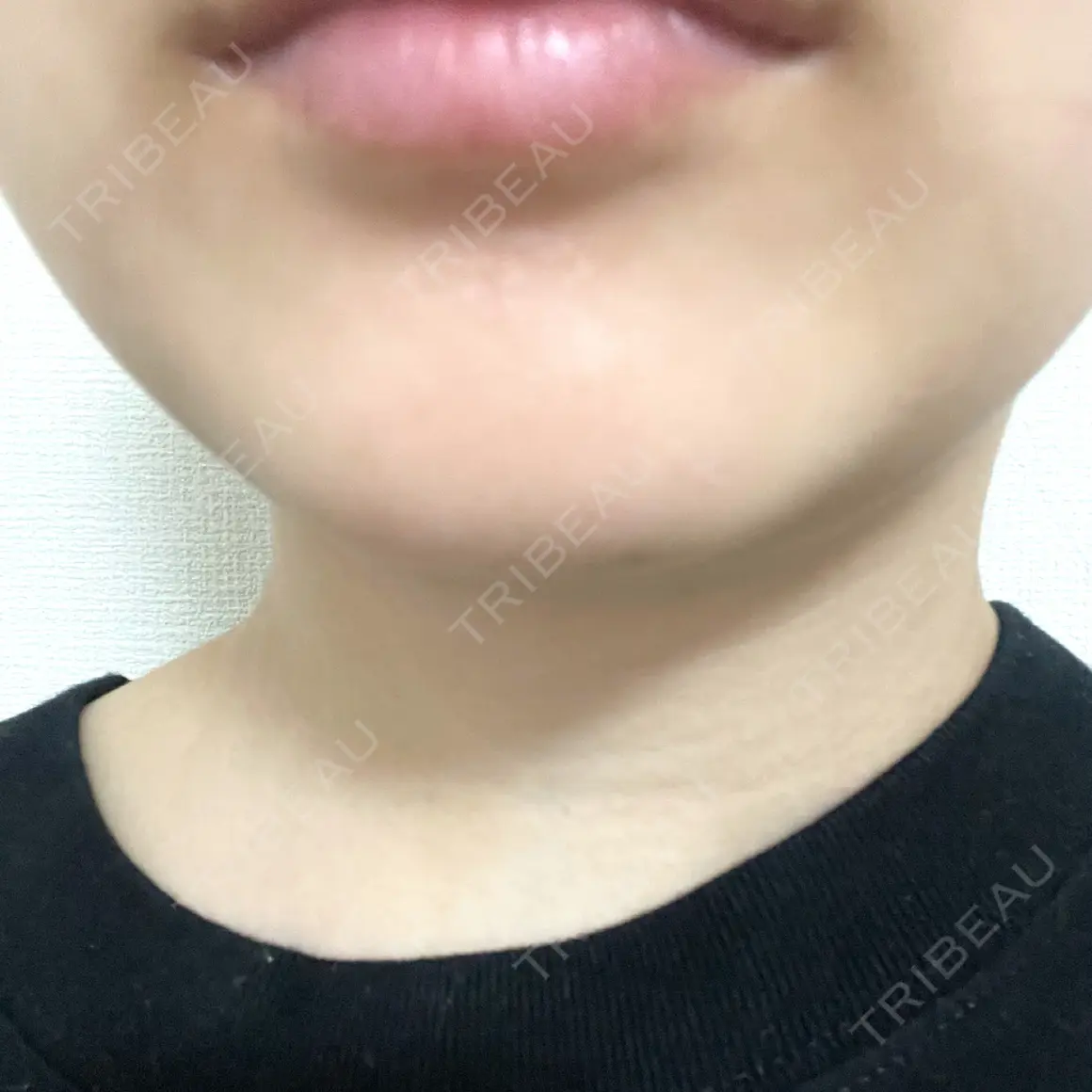 ボトックス（あご） ルラ美容クリニック 札幌院 AFTER