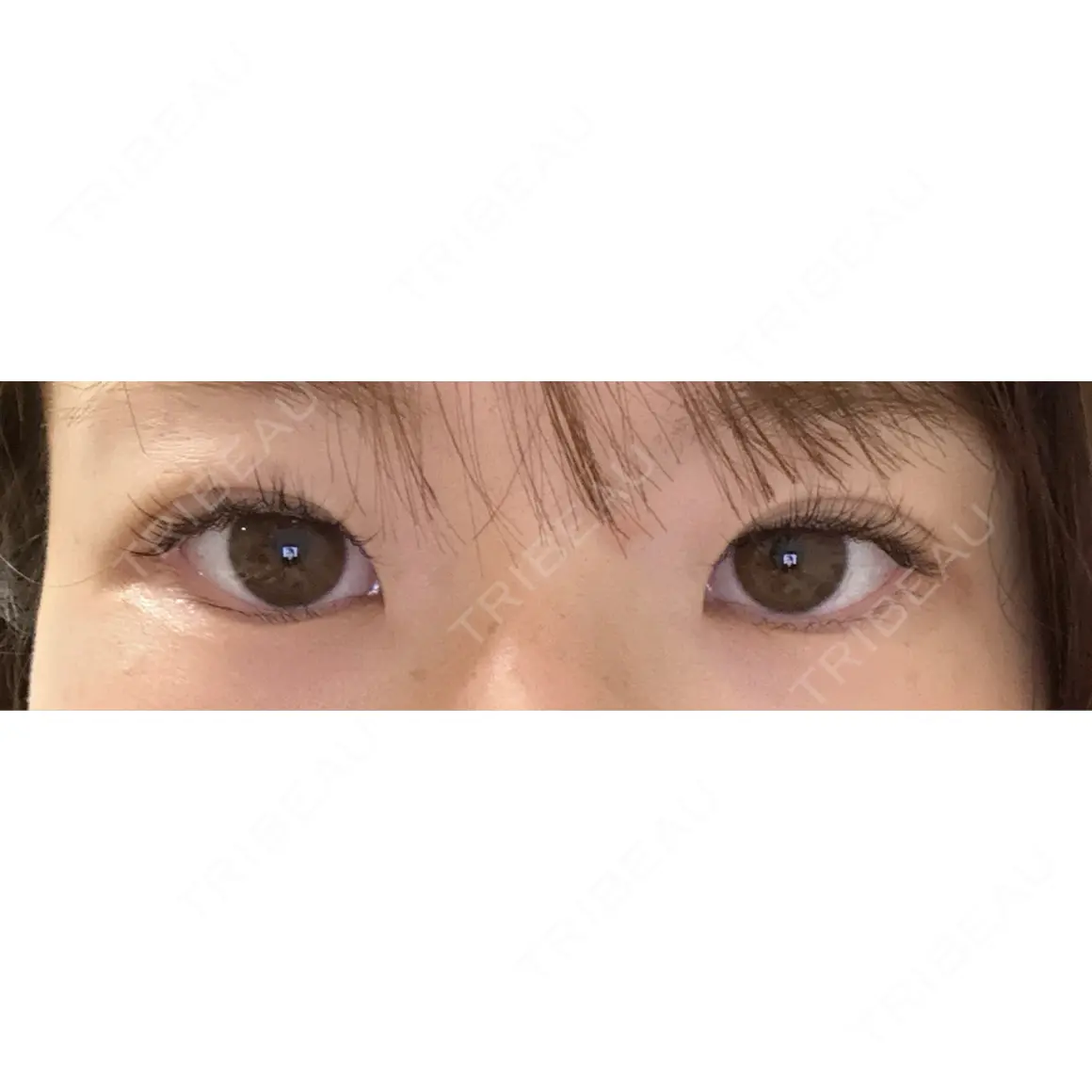 二重埋没 Stand by Beauty Clinic DAY 0