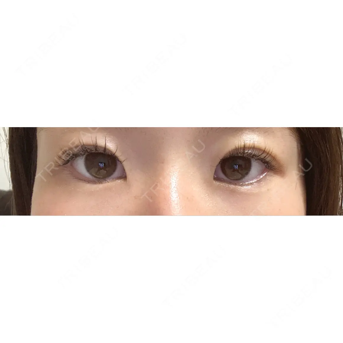 二重埋没 Stand by Beauty Clinic AFTER
