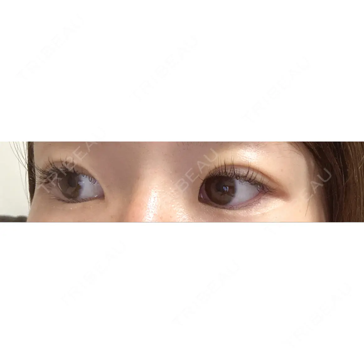 二重埋没 Stand by Beauty Clinic AFTER