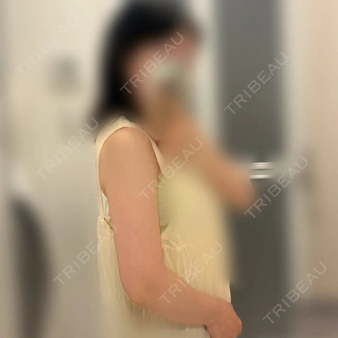 脂肪溶解注射（二の腕） ルラ美容クリニック 大阪心斎橋院 AFTER
