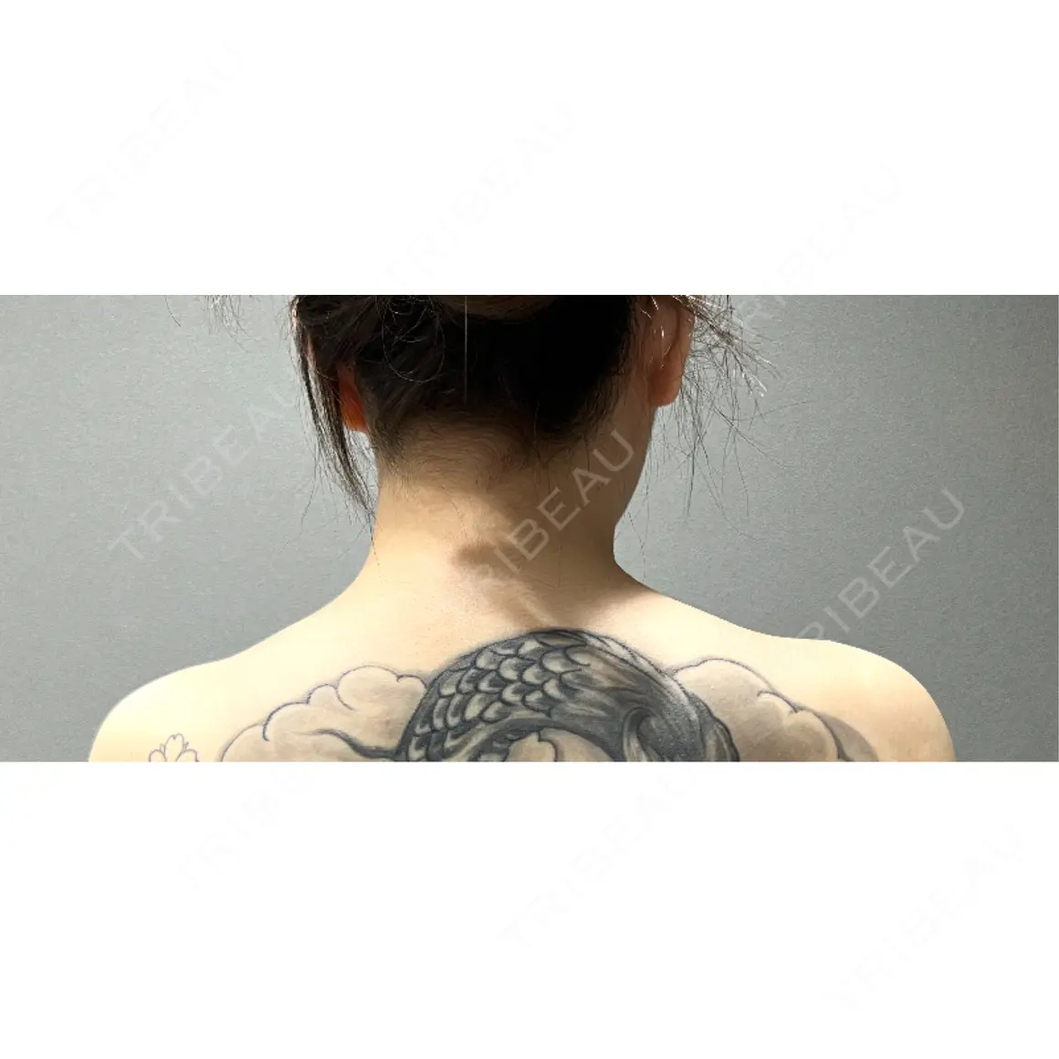 ボトックス（肩） YBC横浜美容外科 大宮院 DAY 0
