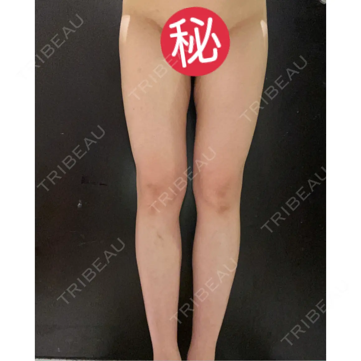 豊胸（脂肪注入） ルーチェクリニック 銀座院 AFTER