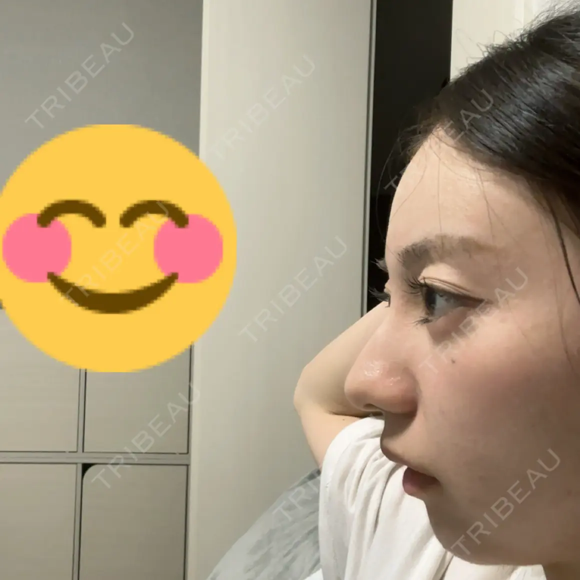 脂肪注入（肌） / 脂肪注入（額） / 脂肪注入（目の下） ルーチェクリニック 銀座院 AFTER