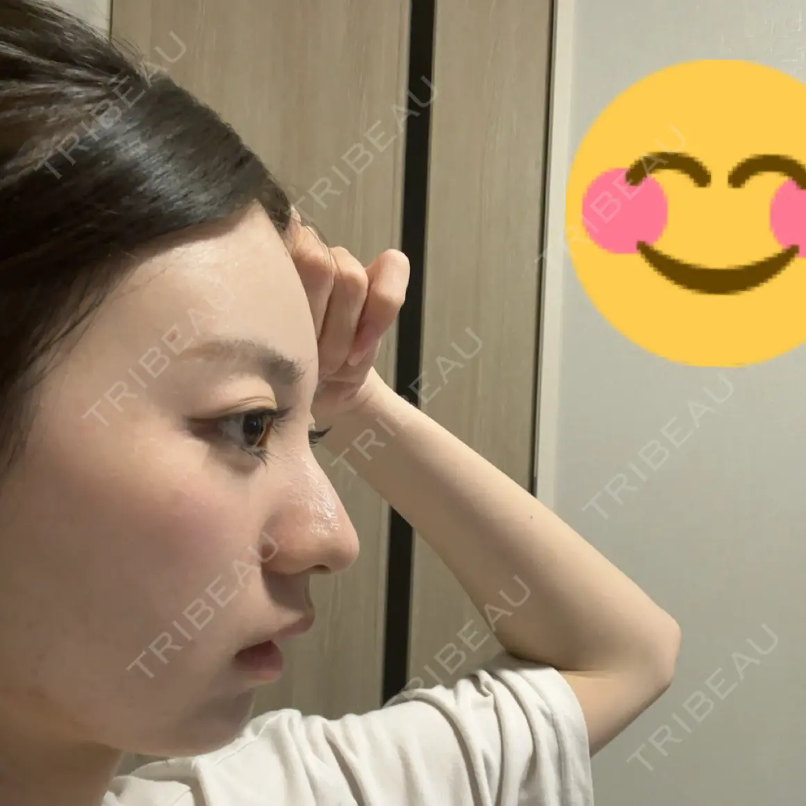 脂肪注入（肌） / 脂肪注入（額） / 脂肪注入（目の下） ルーチェクリニック 銀座院 AFTER