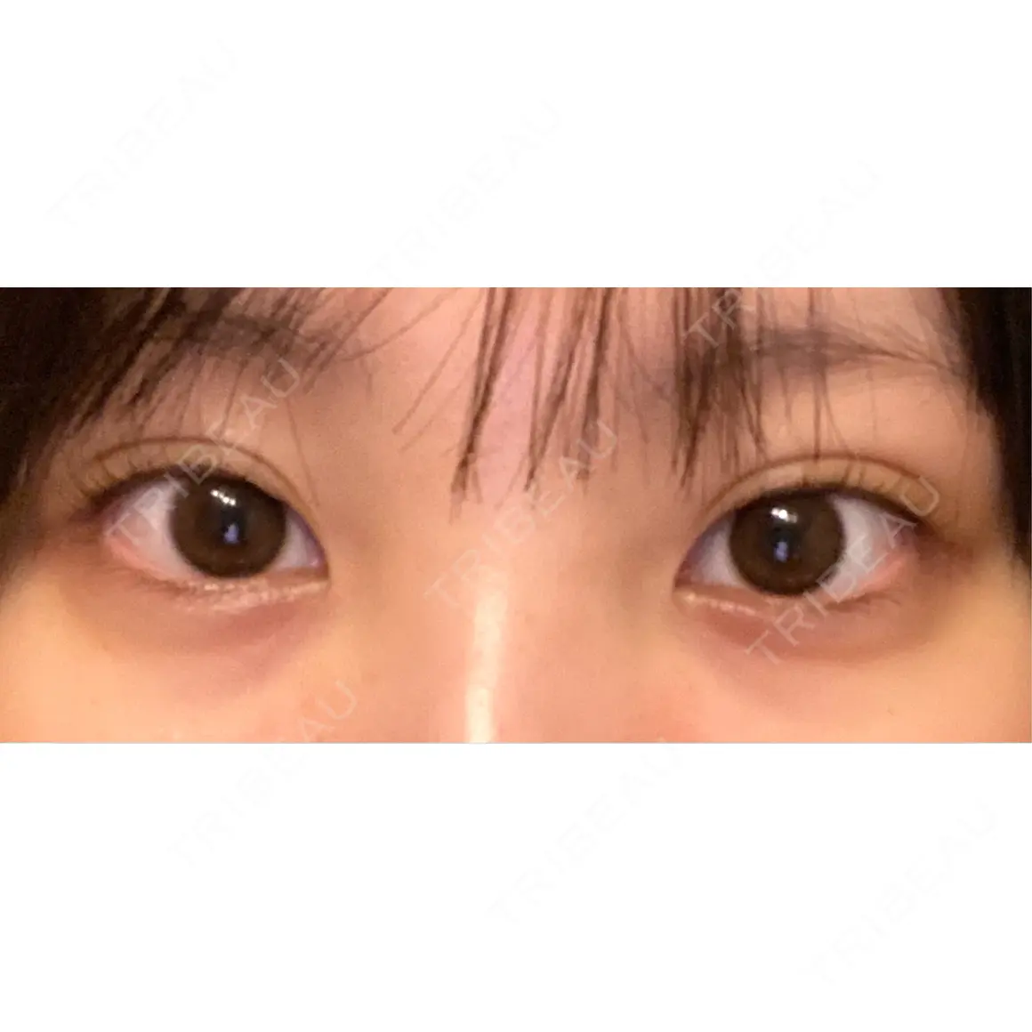 二重埋没 湘南美容クリニック 池袋東口院 AFTER