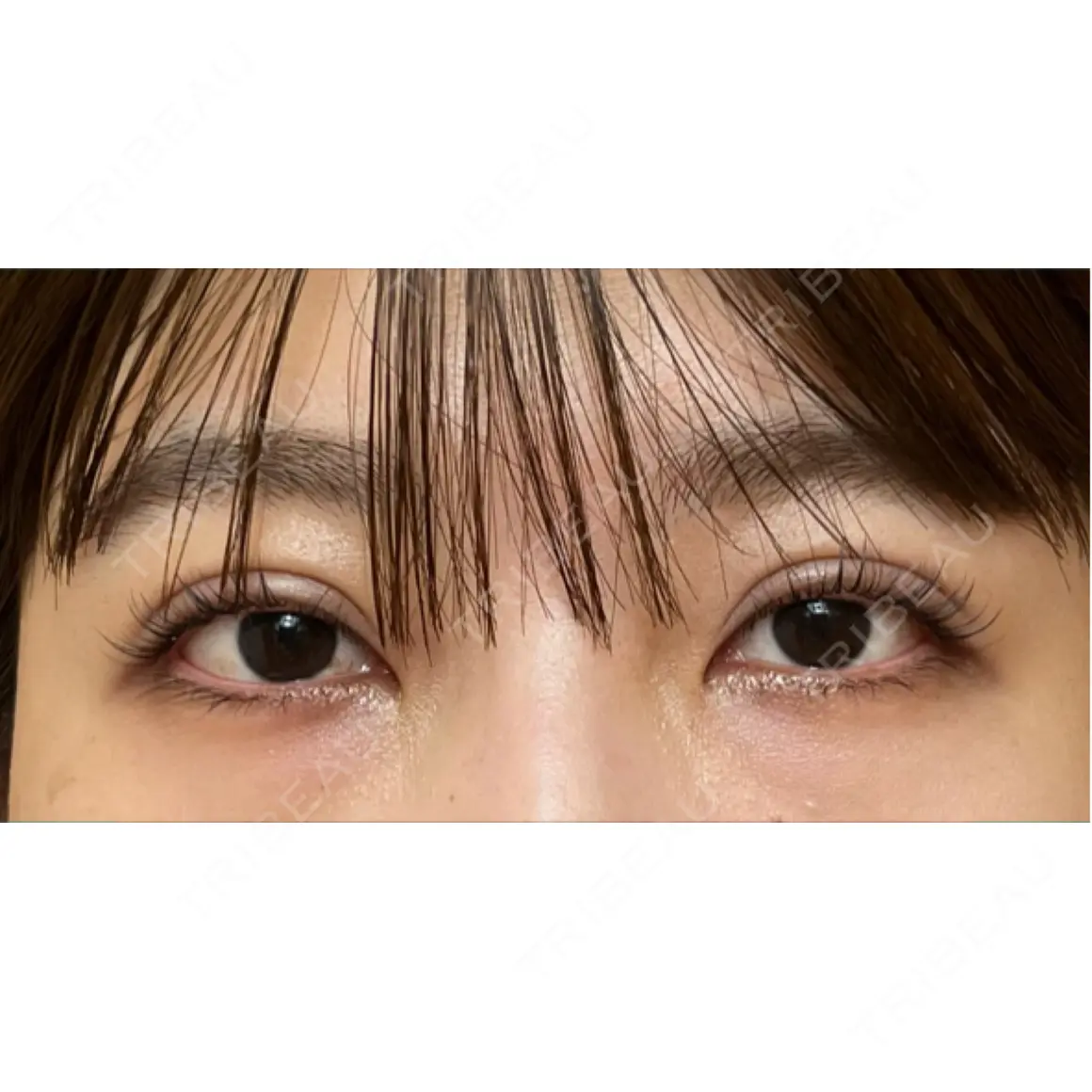 二重埋没 湘南美容クリニック 池袋東口院 AFTER