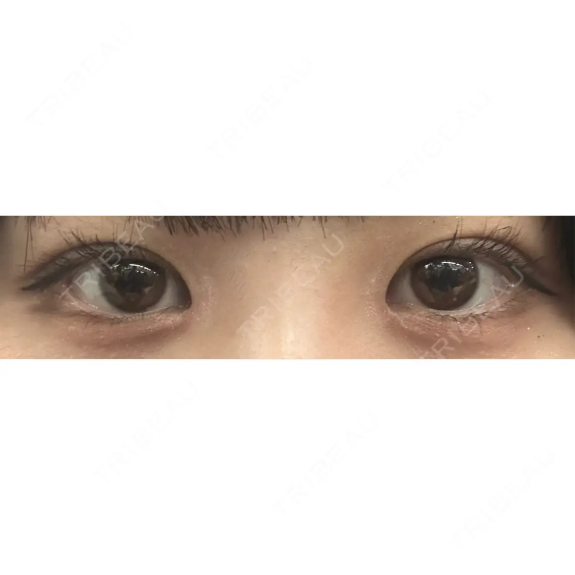 二重埋没 / 目頭切開 / 上まぶたの脂肪取り 9BeautyClinic AFTER